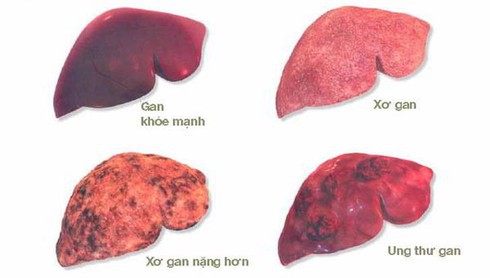 5 thủ phạm “quật ngã” lá gan của người Việt - Ảnh 1.