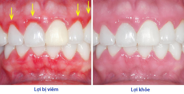 11 lý do khiến bệnh viêm khớp dạng thấp tấn công nhiều người: Nên điều chỉnh lại ngay - Ảnh 4.