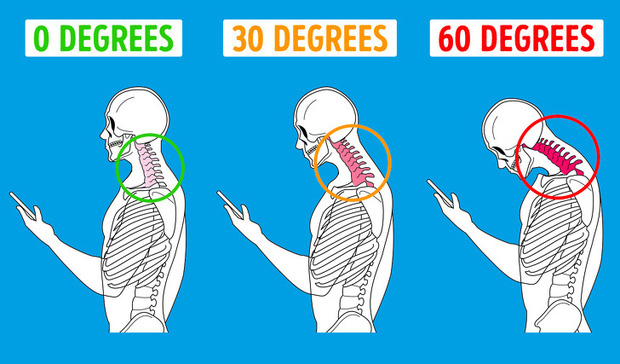Hội chứng kỳ lạ do tư thế rất nhiều người trong chúng ta đang mắc phải trong thời đại smartphone ngập tràn thế giới - Ảnh 4.