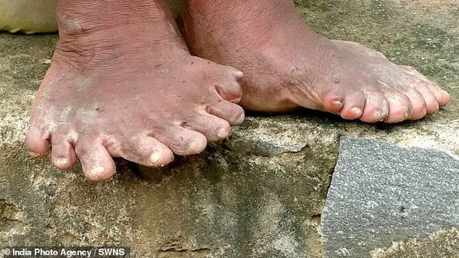 Có đến 12 ngón tay, 19 ngón chân do dị tật bẩm sinh, người phụ nữ phải trốn chui trốn nhủi trong nhà vì bị đồn là phù thủy - Ảnh 2.