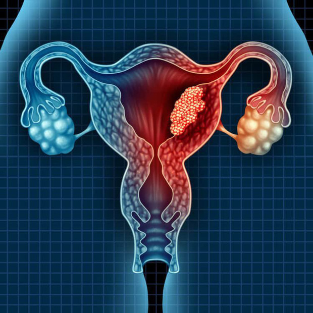5 căn bệnh ở buồng trứng dễ gây vô sinh mà phái nữ không nên chủ quan bỏ qua - Ảnh 1.