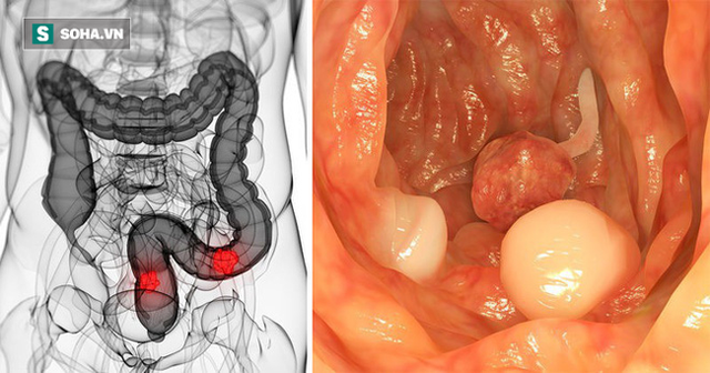 PGĐ Bệnh viện K mách 4 dấu hiệu ung thư đại trực tràng: Dấu hiệu thứ 2 dễ nhận biết nhất - Ảnh 2.
