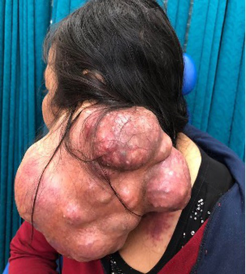 Cắt khối u 3kg đeo bám trên cổ người phụ nữ suốt 25 năm - Ảnh 1.