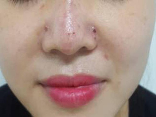 Lại thêm nạn nhân mù mắt do tiêm filler: BS nghìn like khuyên 10 điều cần nhớ khi làm đẹp - Ảnh 1.