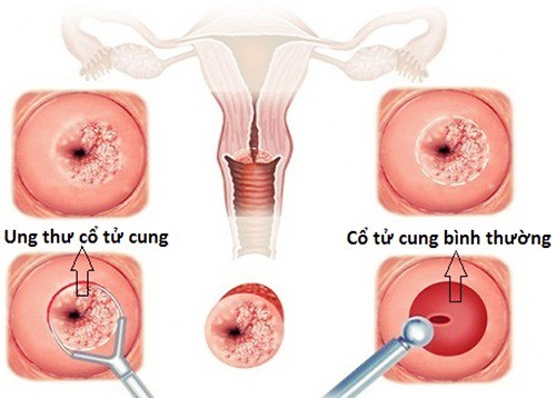 Những xét nghiệm phụ nữ nhất định phải biết để kiểm tra tiền ung thư cổ tử cung - Ảnh 1.