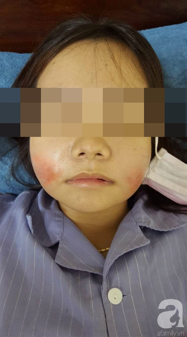 Cô gái nhập viện vì biến chứng sưng đau, nóng rát mặt sau khi tiêm chất làm đầy tại một spa tư nhân - Ảnh 1.