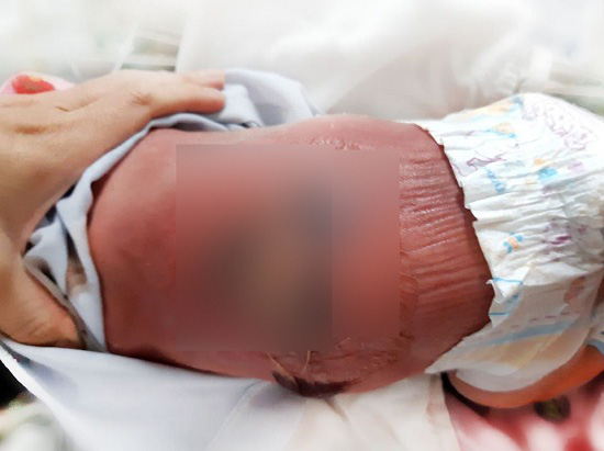Nằm than sưởi ấm  một trẻ sơ sinh bị bỏng nặng, nhiễm trùng máu - Ảnh 1.