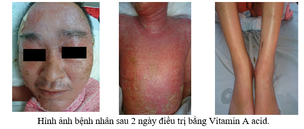 Người đàn ông đóng vảy toàn thân sau tiêm corticoid, dùng thuốc nam chữa vảy nến - Ảnh 2.