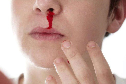 Chảy máu mũi thường xảy ra vào mùa nào? - Ảnh 1.