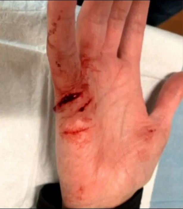 Đang đi mua sắm tại siêu thị, người phụ nữ bất ngờ bị một lưỡi dao cạo giấu trong tay cầm xe đẩy làm bị thương nghiêm trọng - Ảnh 1.