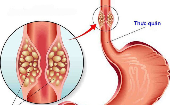 Ung thư thực quản - bệnh hay gặp ở người hút thuốc và uống rượu: 3 dấu hiệu cần khám ngay - Ảnh 2.