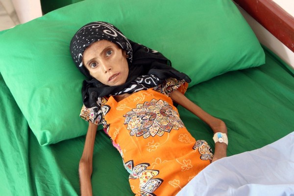 Xót xa bức ảnh bé gái da bọc xương và sự thật tàn khốc phía sau khiến 10 triệu người chết đói - Ảnh 2.