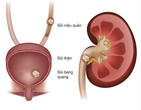 6 sai lầm gây hại thận - Ảnh 1.