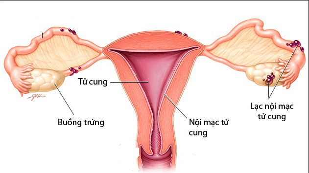 3 nguyên nhân phụ nữ dễ bị hiếm muộn - Ảnh 1.