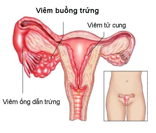 3 nguyên nhân phụ nữ dễ bị hiếm muộn - Ảnh 2.