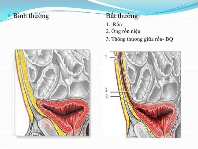 Rốn bất ngờ chảy dịch, người phụ nữ bàng hoàng biết mình mắc bệnh lý ít gặp - Ảnh 2.