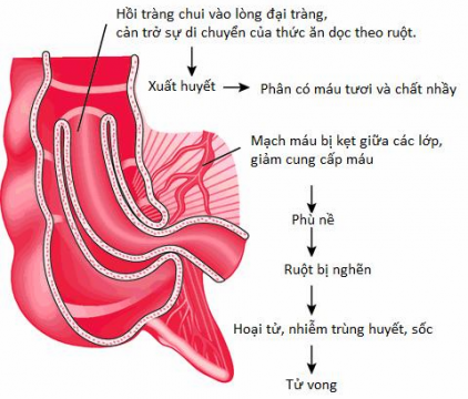 4 dấu hiệu chứng tỏ trẻ bị lồng ruột, cha mẹ cần lưu ý - Ảnh 2.