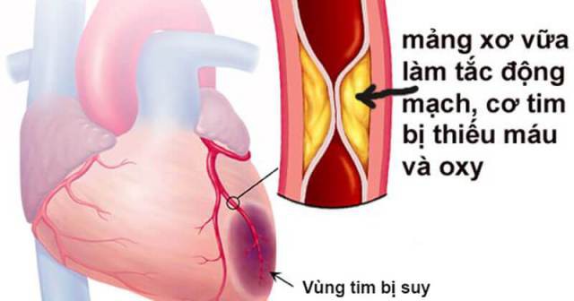 Đau ngực vào viện đã nhồi máu cơ tim suýt chết, bác sĩ chỉ cách tránh xa bệnh này - Ảnh 2.