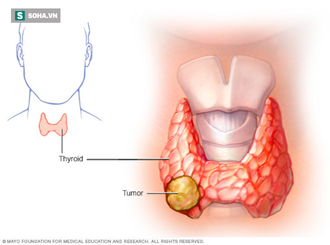 4 người trong nhà cùng mắc ung thư tuyến giáp: PCT Hội Ung thư chỉ dấu hiệu phát hiện sớm - Ảnh 1.