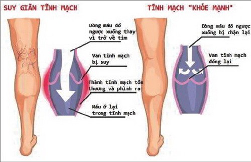 Phép trị viêm tắc tĩnh mạch của Đông y - Ảnh 1.