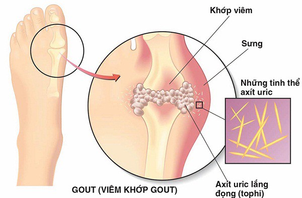 Bệnh gút: Các sai lầm thường gặp - Ảnh 1.