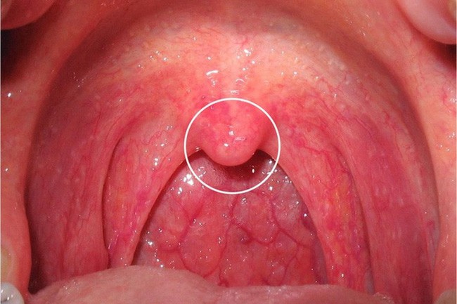 Nước bọt tiết nhiều ở khoang miệng là triệu chứng cảnh báo một vài vấn đề sức khỏe mà bạn không nên xem thường - Ảnh 2.