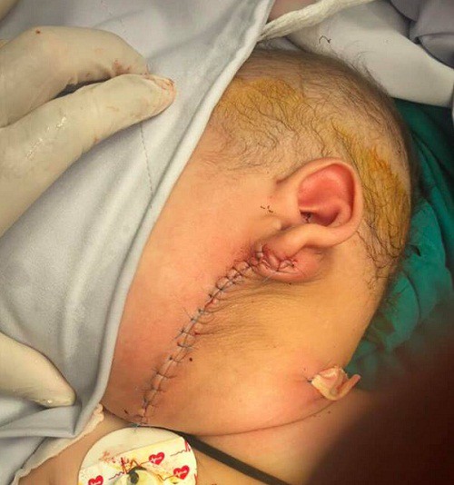 Bé trai có u khủng to bằng quả bưởi ở má được phẫu thuật tạo hình thành công - Ảnh 2.