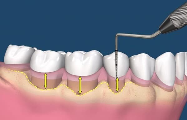 Ðối phó với chứng tụt lợi - Ảnh 1.