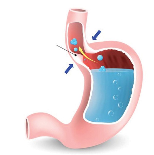 Nuốt nghẹn kéo dài, coi chừng co thắt tâm vị - Ảnh 2.