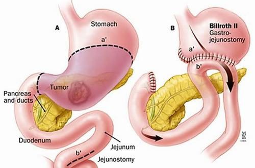 Cắt dạ dày giảm béo: Phương pháp này dành cho ai? - Ảnh 1.