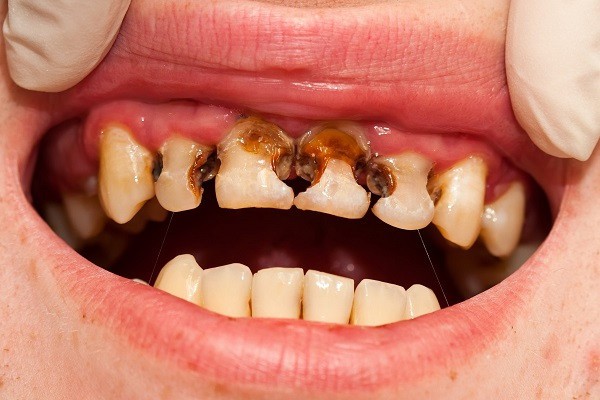 90% người Việt mắc bệnh về răng này: Chuyên gia chỉ ra hai nguyên nhân - Ảnh 1.
