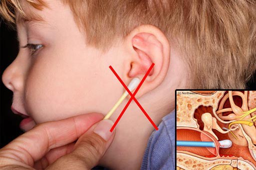 Từ vụ nhiễm trùng não do dùng tăm bông ngoáy tai, bác sĩ chỉ cách vệ sinh tai an toàn, hiệu quả - Ảnh 3.