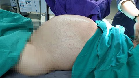 Bé gái sơ sinh nặng 2,1 kg mang khối bướu quái gấp 1,5 lần cơ thể - Ảnh 2.