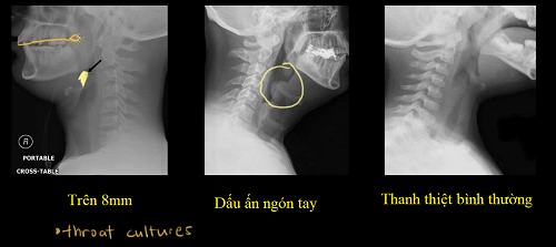 Đột ngột đau họng, khó nuốt, coi chừng mắc căn bệnh nguy hiểm này - Ảnh 1.