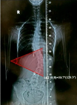 Cô gái 16 tuổi bị cong cột sống 50 độ vì xem điện thoại ở tư thế này và lời khuyến cáo của bác sĩ - Ảnh 2.