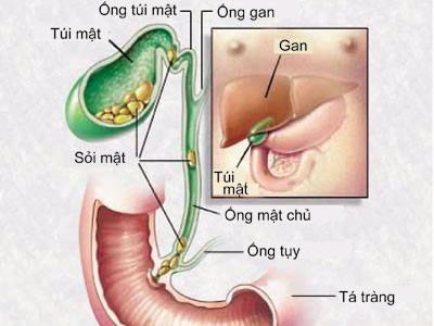 Châm cứu chữa sỏi mật và sỏi tiết niệu - Ảnh 1.