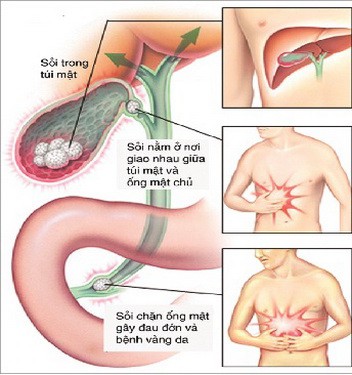 Phát hiện và điều trị sớm bệnh sỏi mật - Ảnh 1.