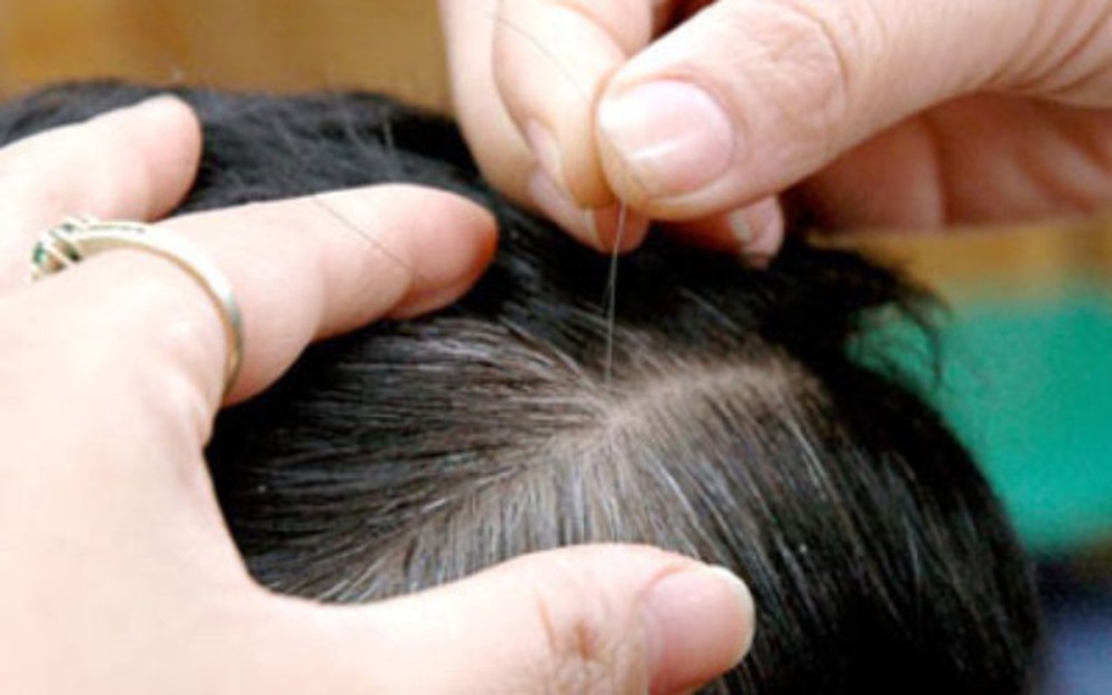 T&oacute;c bạc c&oacute; n&ecirc;n nhổ: B&aacute;c sĩ khẳng định kh&ocirc;ng n&ecirc;n v&igrave; rất nhiều t&aacute;c hại  - Ảnh 1.