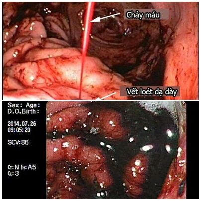 Người có bệnh viêm loét dạ dày, nếu gặp dấu hiệu sau là đã biến chứng, cần nhập viện ngay - Ảnh 2.