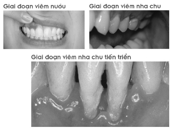 Viêm nướu răng - Bệnh tuy nhẹ nhưng chớ xem thường - Ảnh 1.