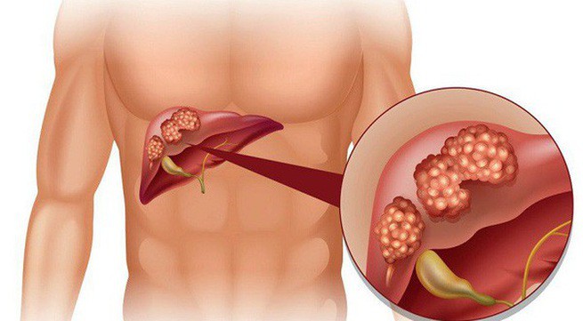 Tuyệt đối không coi thường viêm gan B dù là thể ngủ, nếu có virus phải nhớ những điều sau - Ảnh 1.