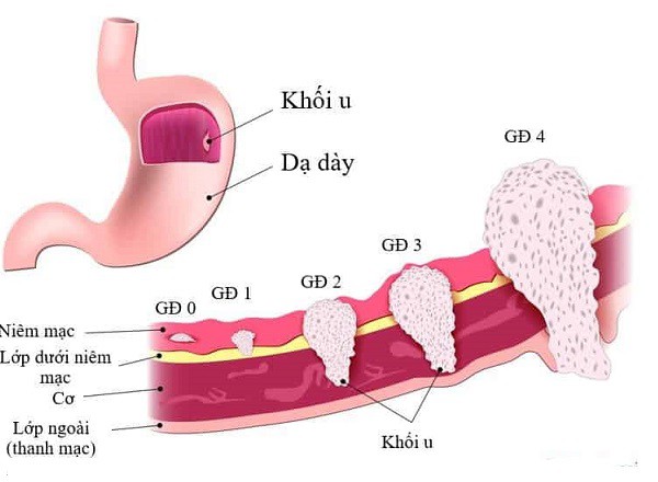 Người mẫu 8x qua đời ở tuổi 37 vì ung thư dạ dày, chuyên gia khuyến cáo gì? - Ảnh 3.