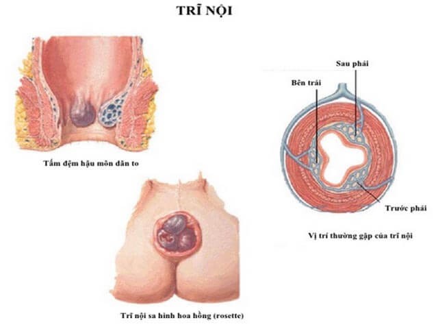 Bệnh trĩ và những nỗi đau thầm kín khó nói  - Ảnh 3.