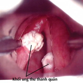 Có dấu hiệu này trên 10 ngày không hết phải khám ngay kẻo ung thư, nhất người hút thuốc - Ảnh 1.