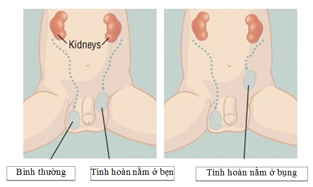 Tinh hoàn nằm trong ổ bụng, bé trai 5 tuổi được nội soi hạ về “đúng vị trí” - Ảnh 2.