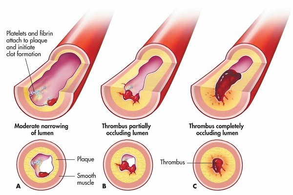 5 triệu chứng ngầm cảnh báo về bệnh huyết khối: Hậu quả nặng nề có thể bạn chưa biết - Ảnh 2.