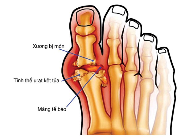 Cảnh giác cơn gút - Ảnh 1.