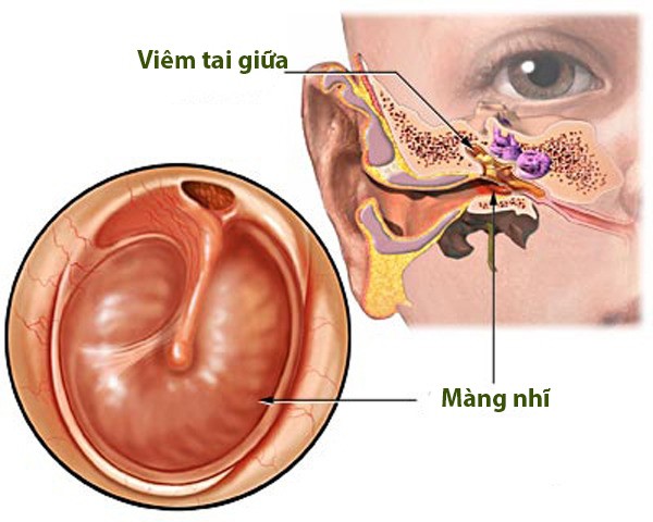 Chuyên gia chỉ cách chăm sóc trẻ viêm tai giữa, tránh biến chứng lên não - Ảnh 1.