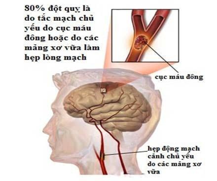 Bệnh mạch máu não: Phòng ngừa từ các yếu tố nguy cơ - Ảnh 1.