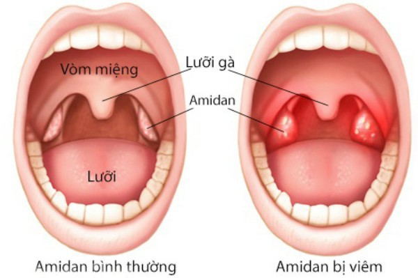 Chữa viêm amidan trong tầm tay với phương pháp đơn giản - Ảnh 1.